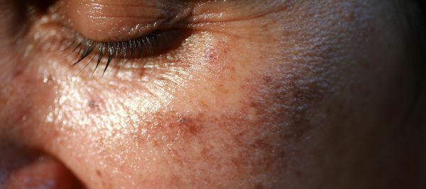 HOW TO GET RID OF PIGMENTATION? CAUSES, PRECAUTION & TREATMENT